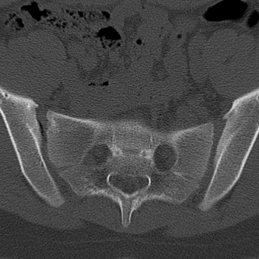 Bilateral pars defect (Radiopaedia 26691-26846 Axial bone window 94).jpg