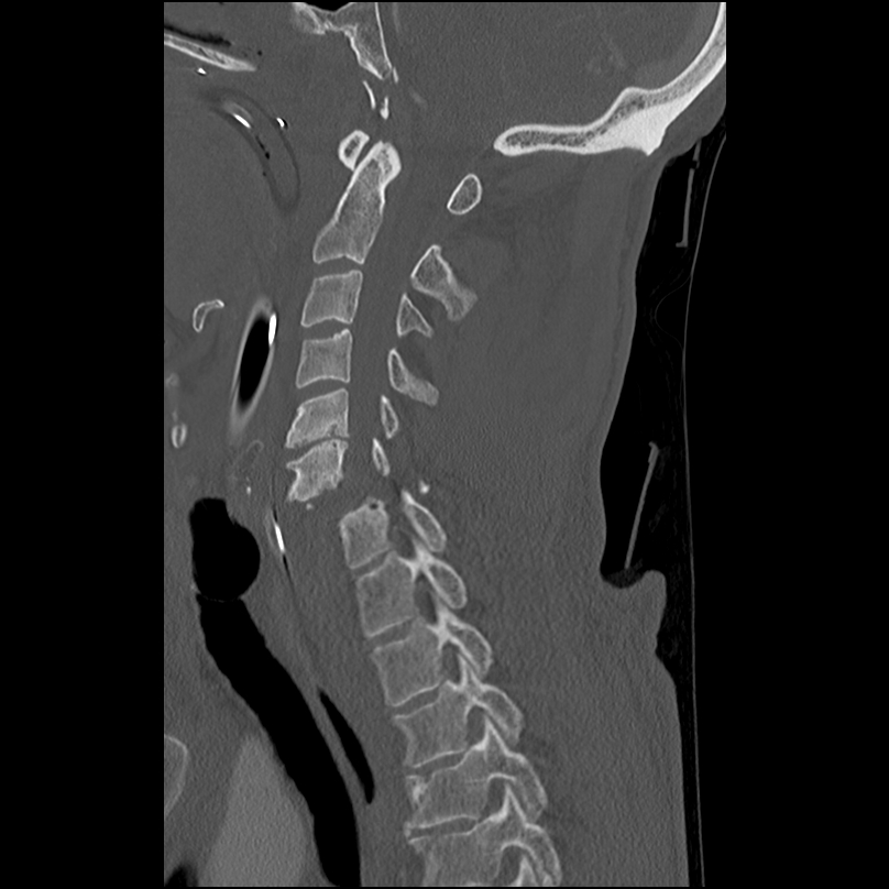 Bilateral perched facets with cord injury (Radiopaedia 45587-49713 Sagittal bone window 23).jpg