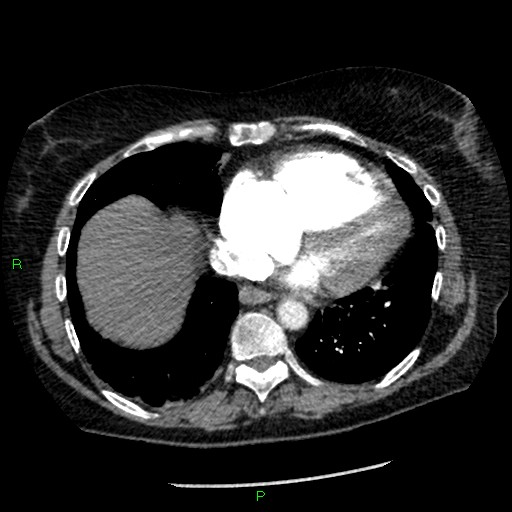 Bilateral pulmonary emboli (Radiopaedia 32700-33669 Axial C+ CTPA 80).jpg