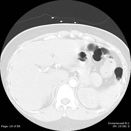 Bilateral pulmonary emboli with Hampton hump sign (Radiopaedia 54070-60246 Axial lung window 10).jpg