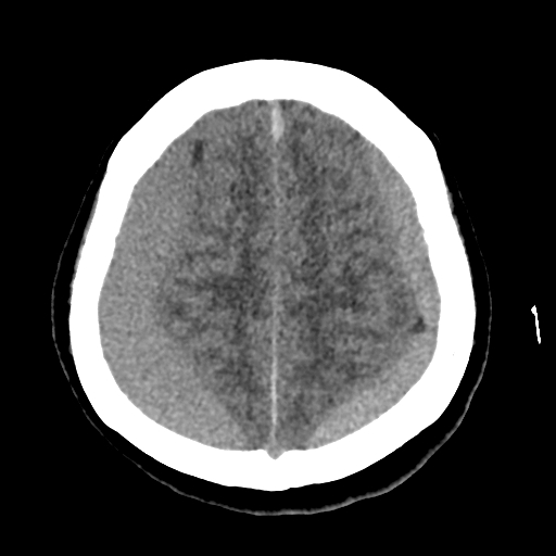 Bilateral subacute subdural hematoma (Radiopaedia 69240-79018 Axial non-contrast 39).jpg