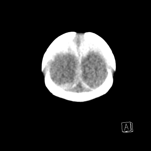 File:Bilateral subdural hemorrhage and parietal skull fracture (Radiopaedia 26058-26192 Coronal non-contrast 27).png
