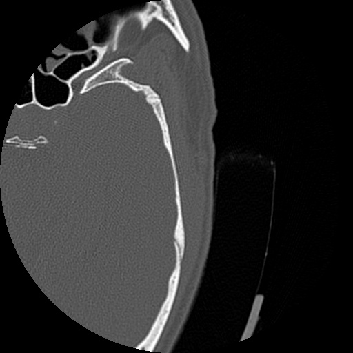 Bilateral temporal bone fractures (Radiopaedia 29482-29970 D 149).jpg