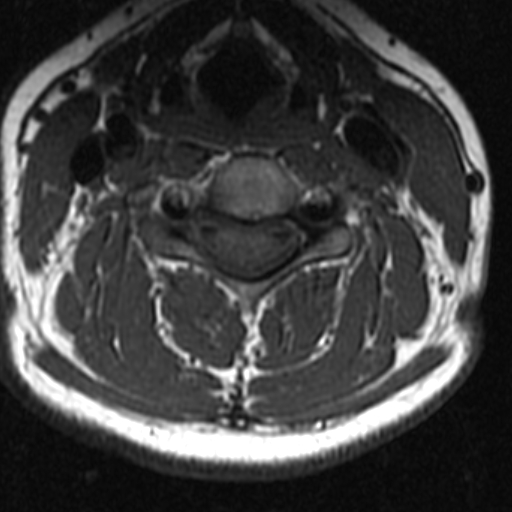 File:Bilateral tortuous vertebral arteries (Radiopaedia 19070-19039 Axial T2 11).jpg