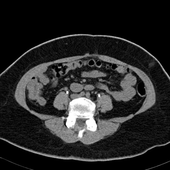 Bilateral ureteric stents (Radiopaedia 48795-53825 Axial non-contrast 37).jpg