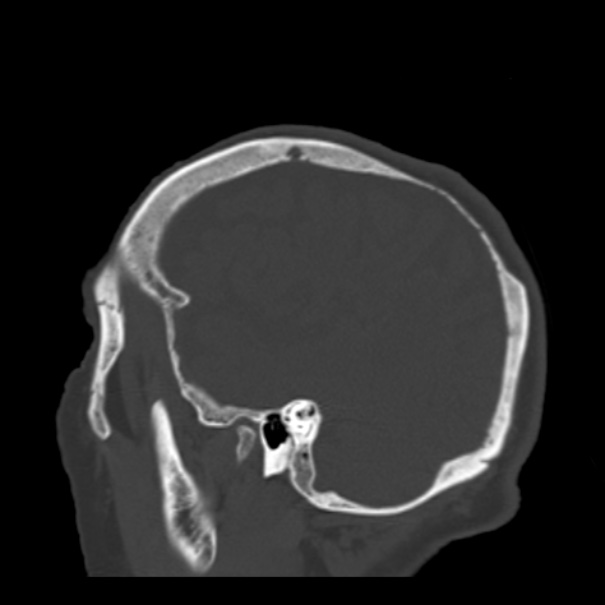 Biparietal osteodystrophy (Radiopaedia 46109-50463 Sagittal bone window 25).jpg