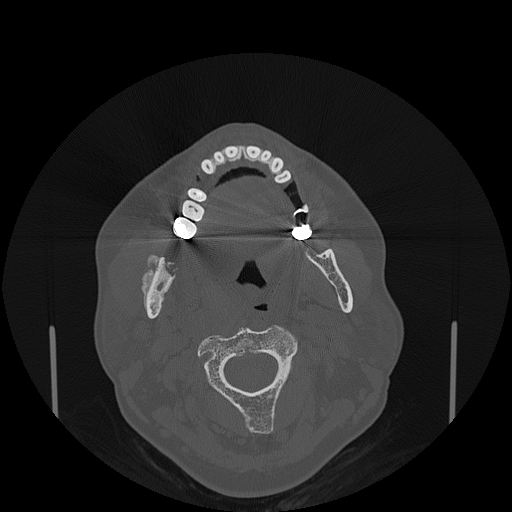 File:Bisphosphonate-related osteonecrosis of the jaw (Radiopaedia 71324-81642 Axial bone window 86).jpg