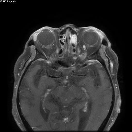 File:Bisphosphonate-related osteonecrosis of the maxilla (Radiopaedia 51367-57101 Axial T1 C+ fat sat 38).jpg
