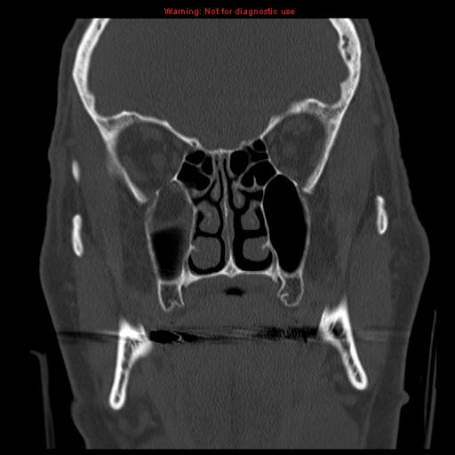 File:Blowout fracture with inferior rectus entrapment (Radiopaedia 12418-12673 Coronal bone window 12).jpg