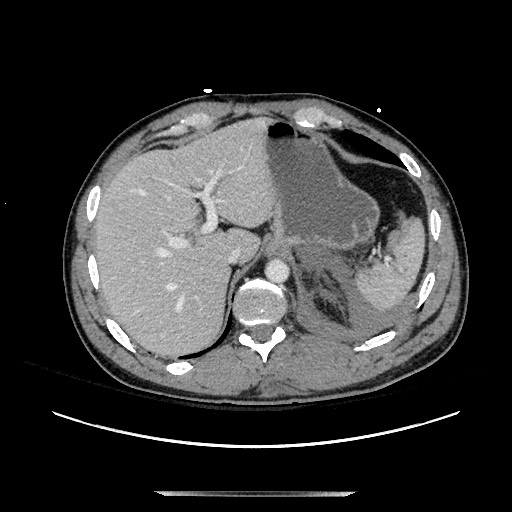 Blunt abdominal trauma with solid organ and musculoskelatal injury with active extravasation (Radiopaedia 68364-77895 A 26).jpg