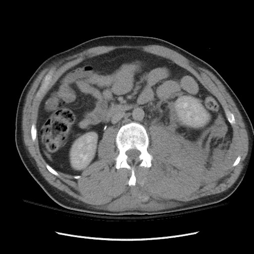 Blunt abdominal trauma with solid organ and musculoskelatal injury with active extravasation (Radiopaedia 68364-77895 Axial C+ delayed 64).jpg
