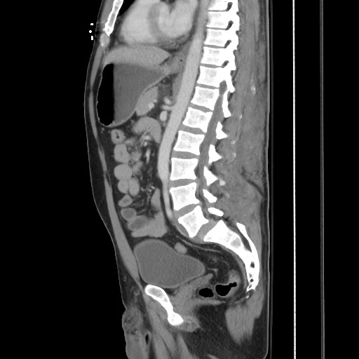 Blunt abdominal trauma with solid organ and musculoskelatal injury with active extravasation (Radiopaedia 68364-77895 C 81).jpg