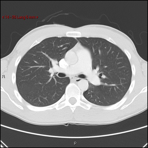 Blunt chest trauma - pulmonary interstitial emphysema and pneumomediastinum (Radiopaedia 20666-20552 Axial lung window 25).jpg