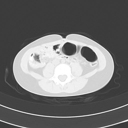 File:Bochdalek diaphragmatic hernia (Radiopaedia 38866-41059 Axial lung window 36).jpg