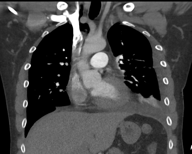 File:Boerhaave syndrome (Radiopaedia 39382-41660 C 39).png