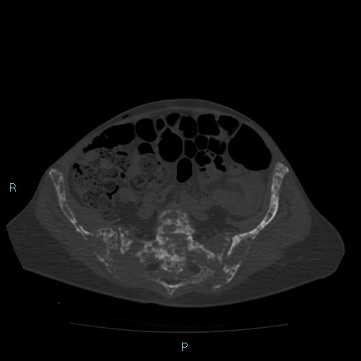 File:Bone metastases from untreated breast cancer (Radiopaedia 42973-46219 Axial bone window 152).jpg