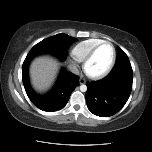 File:Borderline mucinous tumor (ovary) (Radiopaedia 78228-90808 A 33).jpg