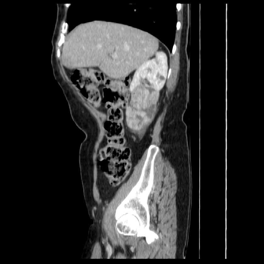 Bosniak renal cyst - type IV (Radiopaedia 22929-22953 G 18).jpg