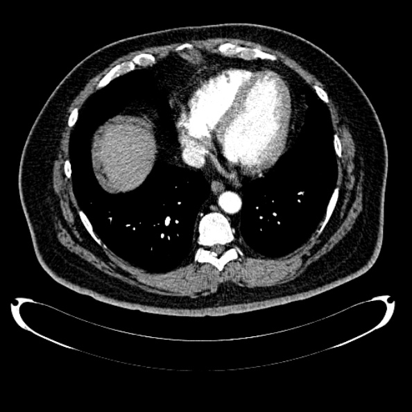 Bosniak renal cyst - type IV (Radiopaedia 24244-24518 B 5).jpg