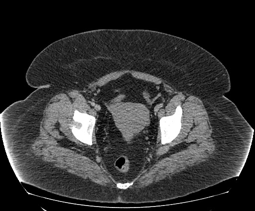 Bowel and splenic infarcts in acute lymphocytic leukemia (Radiopaedia 61055-68913 A 112).jpg