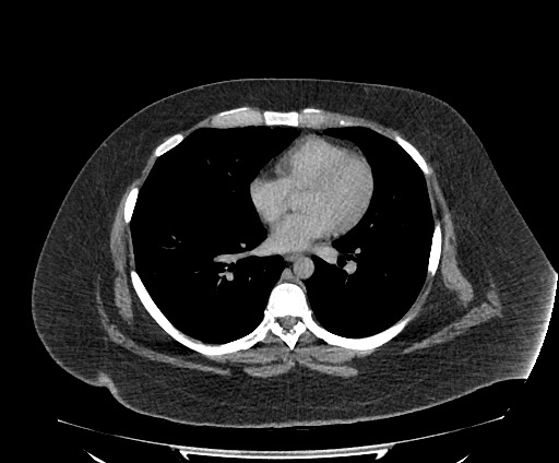 File:Bowel and splenic infarcts in acute lymphocytic leukemia (Radiopaedia 61055-68913 A 6).jpg