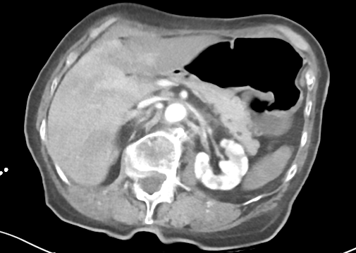 File:Bowel ischemia (Radiopaedia 58273-65382 A 19).png