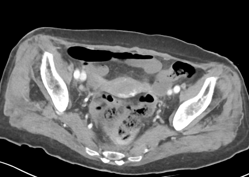 File:Bowel ischemia (Radiopaedia 58273-65382 A 54).png
