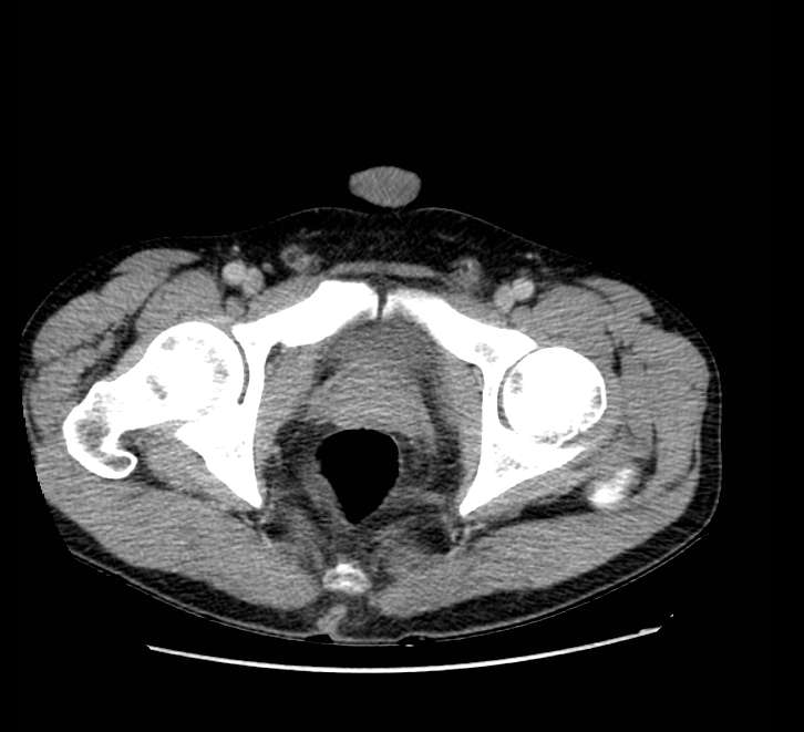 Bowel obstruction from colon carcinoma (Radiopaedia 22995-23028 A 84).jpg