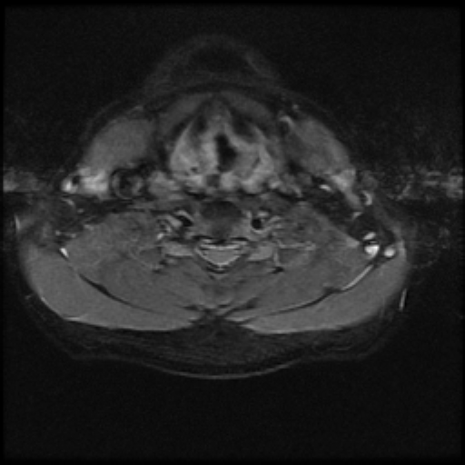 File:Brachial plexus neurofibroma (Radiopaedia 28030-28291 Axial STIR 2).png