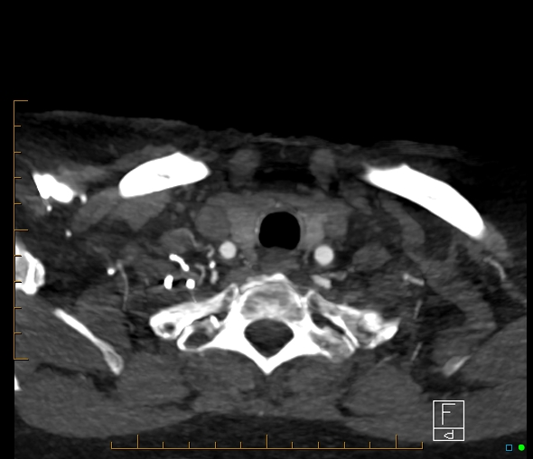 File:Brachiocephalic trunk stenosis (Radiopaedia 87242-103519 A 119).jpg