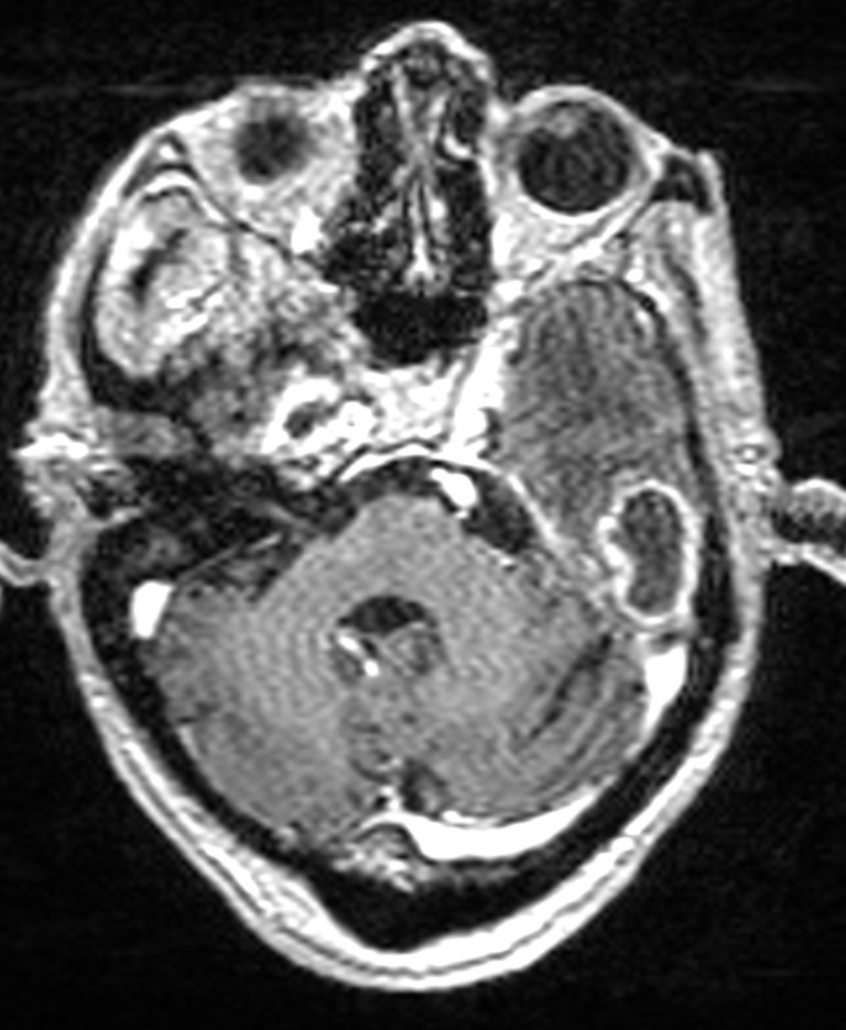 Brain abscess with dual rim sign (Radiopaedia 87566-103938 Axial T1 C+ 47).jpg