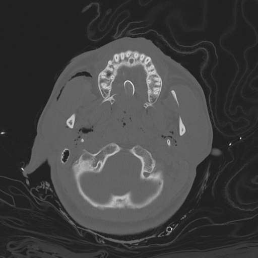 Brain contusions, internal carotid artery dissection and base of skull fracture (Radiopaedia 34089-35339 Axial bone window 41).png