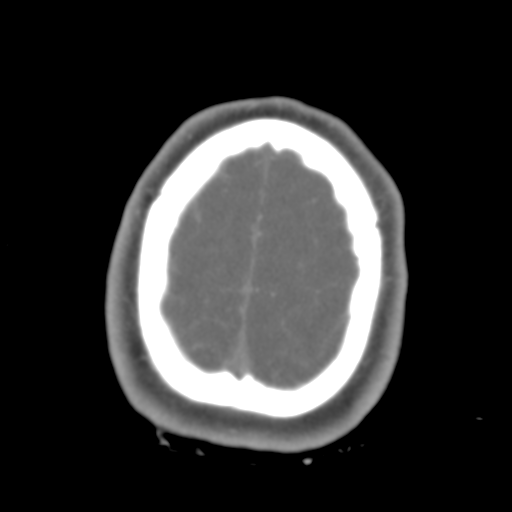 Brain contusions, internal carotid artery dissection and base of skull fracture (Radiopaedia 34089-35339 D 8).png