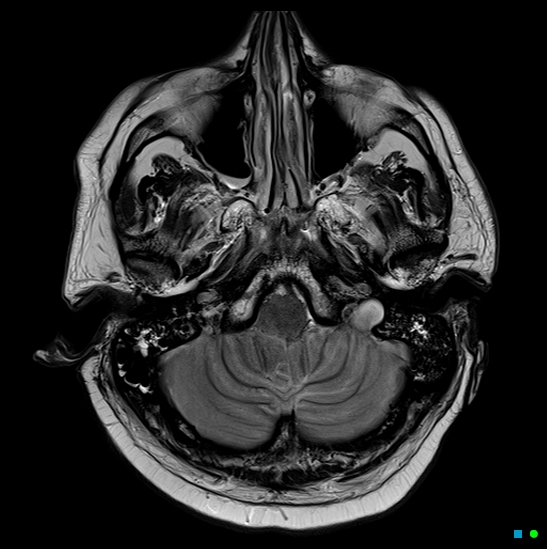 File:Brain death on MRI and CT angiography (Radiopaedia 42560-45689 Axial T2 7).jpg