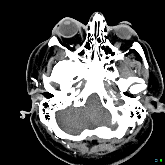 Brain death on MRI and CT angiography (Radiopaedia 42560-45841 B 43).jpg