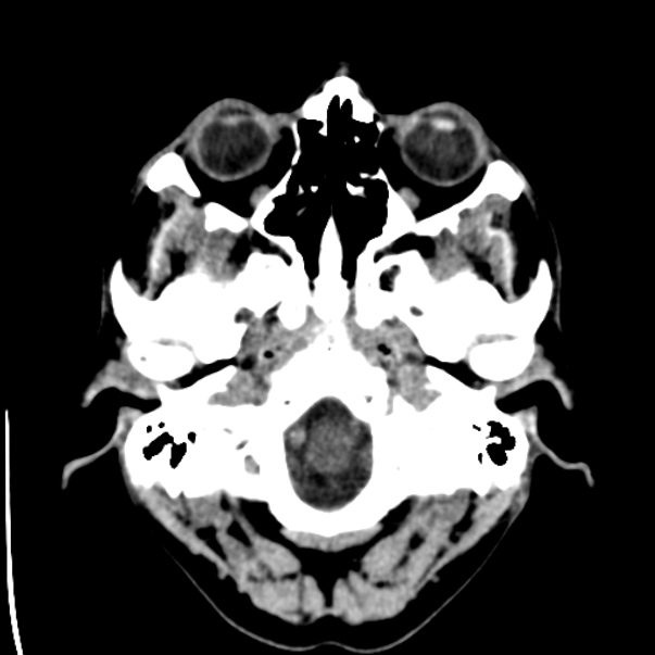 Brain metastases from lung cancer (Radiopaedia 24480-24781 Axial non-contrast 2).jpg