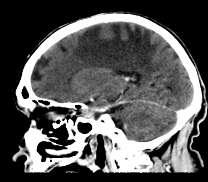Brain metastases from lung cancer (Radiopaedia 27849-28092 Sagittal C+ delayed 25).jpg