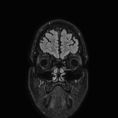 Brain metastases from lung cancer (Radiopaedia 83839-99028 Coronal FLAIR 6).jpg