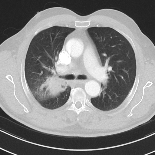Brain metastasis (large cystic mass) (Radiopaedia 47497-52104 Axial lung window 18).png
