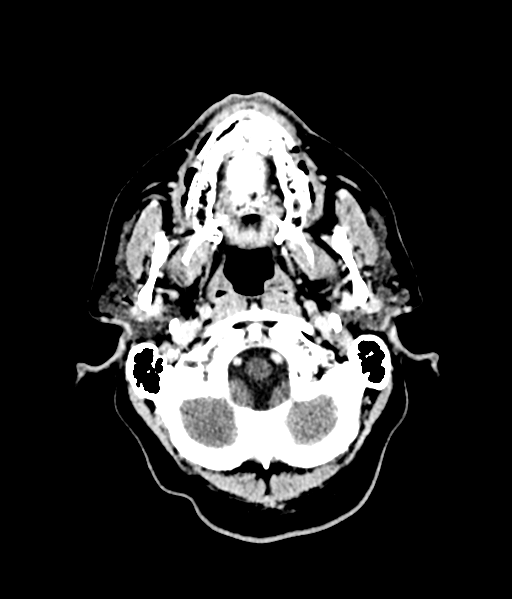 Brain metastasis (large cystic mass) (Radiopaedia 47497-52106 Axial C+ 11).png