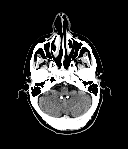 Brain metastasis (large cystic mass) (Radiopaedia 47497-52106 Axial C+ 18).png