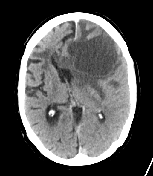 File:Brain metastasis (lung cancer) (Radiopaedia 48289-53177 Axial non-contrast 17).png