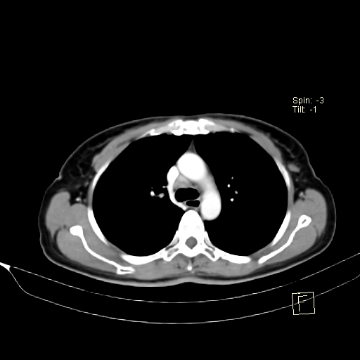 Brain metastasis as initial presentation of non-small cell lung cancer (Radiopaedia 65122-74127 A 17).jpg