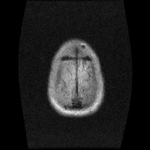 File:Brainstem glioma (Radiopaedia 30923-31624 Axial FLAIR 22).jpg