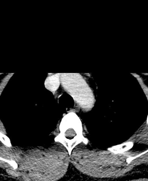 Branchial cleft cyst (Radiopaedia 31167-31875 Axial C+ delayed 77).jpg