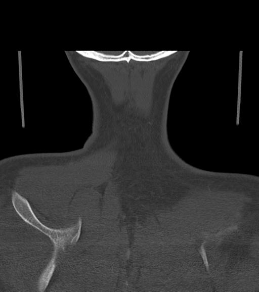 Branchial cleft cyst (Radiopaedia 31167-31875 Coronal bone window 61).jpg