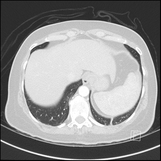 Breast metastases from renal cell cancer (Radiopaedia 79220-92225 Axial lung window 73).jpg