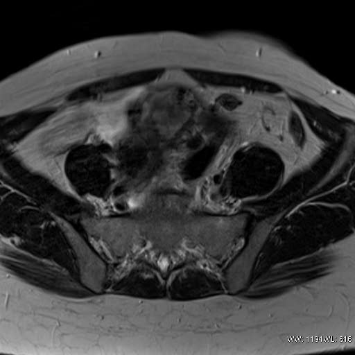 File:Broad ligament fibroid (Radiopaedia 49135-54241 Axial T2 11).jpg