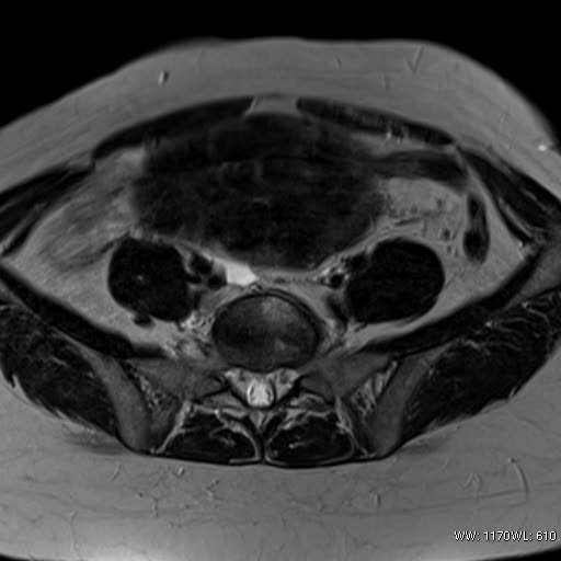 File:Broad ligament fibroid (Radiopaedia 49135-54241 Axial T2 9).jpg