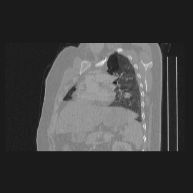 Bronchial atresia (Radiopaedia 60685-68439 Sagittal lung window 56).jpg